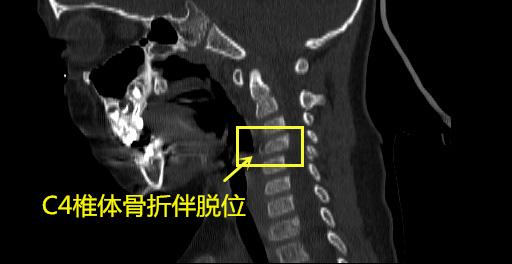 宁波日报|宁波3岁男孩翻跟斗险些瘫痪！提醒：幼童玩耍莫离视线