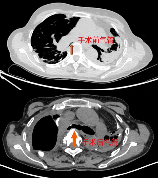 20年气若游丝，气管扁如薄纸，妙手上海医生为患者重建“呼吸要道”