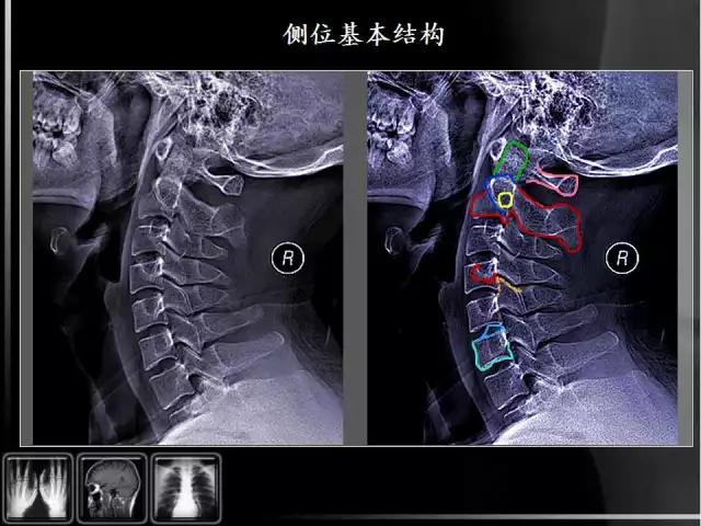 通俗易懂的脊椎X光片读片指南，值得收藏