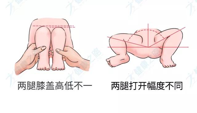 「你的育儿经」这种常见的儿童“骨骼畸形”，很多家长没发现！医生4招教你辨别
