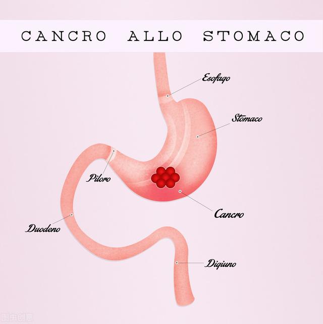 容易被胃癌缠上的3类人，一定要注意了，希望你不是