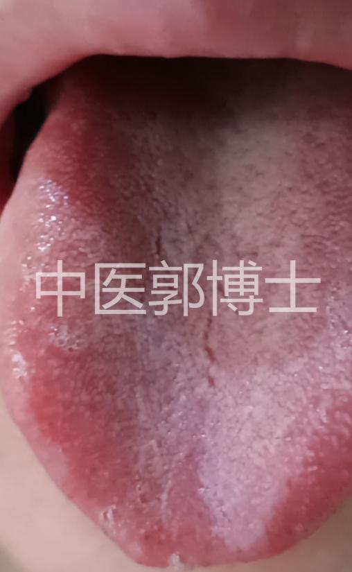 超级宝妈|生完二胎，出虚汗、疲劳、腿沉、睡眠差，选当归六黄汤合温胆汤