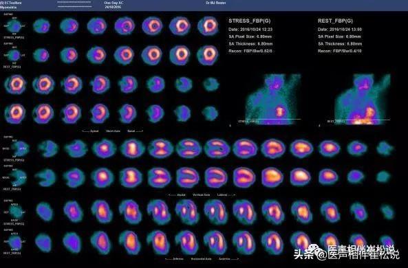 心电图|得了心脏病哪些检查最准确？这份“心脏检查指南”请收好！