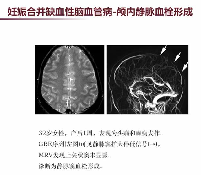 「超级宝妈」张馨：3类需要注意的妊娠合并神经系统疾病