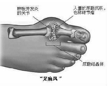 痛风患者的蛋白质摄入
