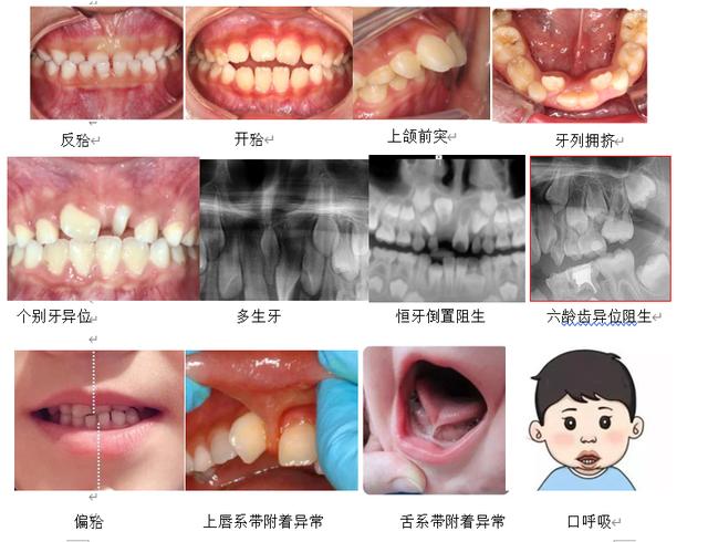 矫治|儿童早期口腔矫治，不单单针对牙齿