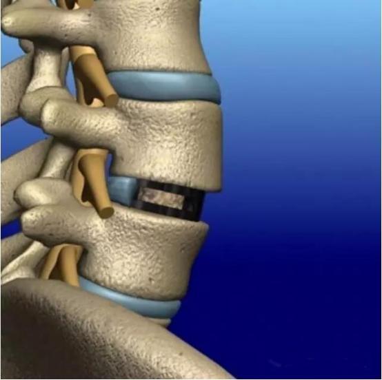 椎间盘|腰椎疾病、腰椎间盘突出你想知道的事全集！