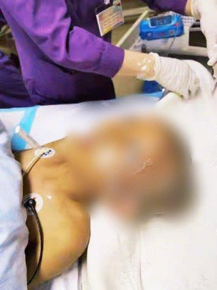 农药|女儿被妈妈用农药焗头驱虱进ICU