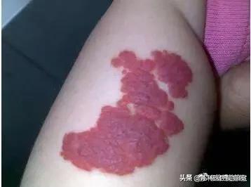 「超级宝妈」患血管瘤的宝宝一定需要处理吗？