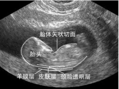 超级宝妈▲怀孕3个月突然腹痛，可不要大意认为是胎动!
