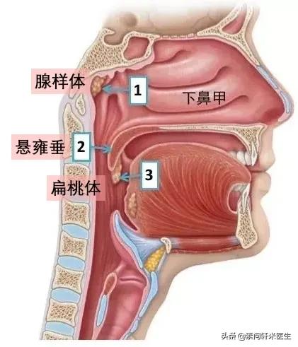 南浔的梦|米医生：腺样体手术后，为何孩子仍打呼、张嘴呼吸、严重黑眼圈？