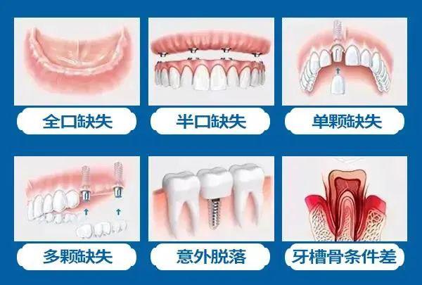 口腔|@全河南人！大河报年末看牙大额减免已全面开启：牙齿矫正每满299元减免150元，种植体低至1520元