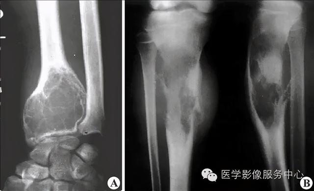 77种骨肌影像病例，助你诊断无忧