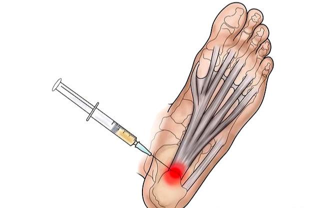 足底筋膜炎导致足底痛，治疗越早效果越好，该咋办？医生告诉您！