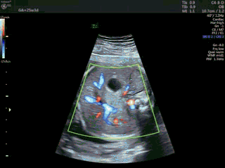 你的育儿经|胎儿下腔静脉缺如