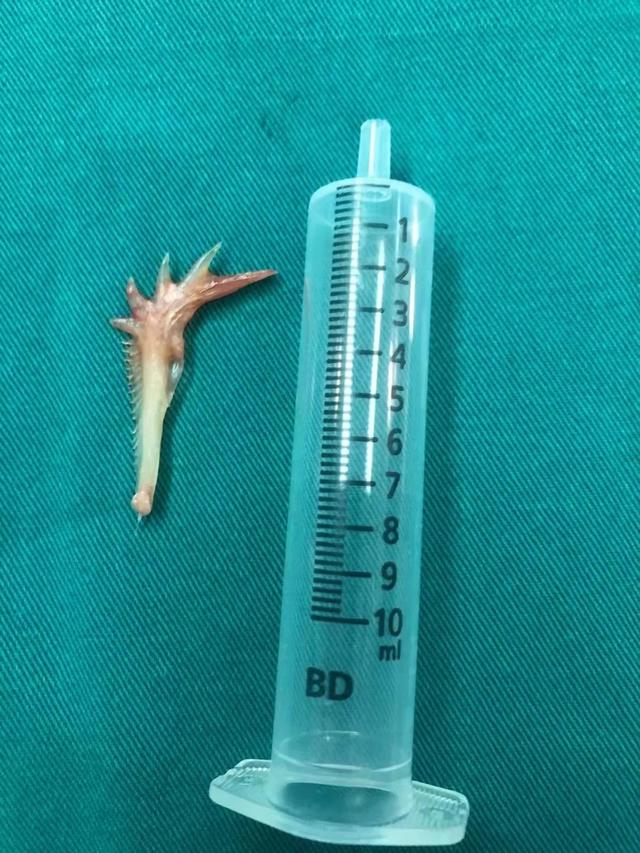 主动脉|10个科室30位专家参与大抢救，就因为一根鱼刺