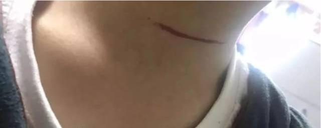 你的育儿经▲因为放风筝夫妻进了ICU