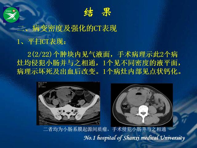 李健丁教授：胃肠道外间质瘤的CT表现和临床病理分析