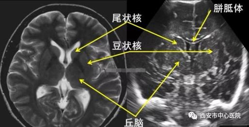 “秘境寻宝”之颅脑术中超声