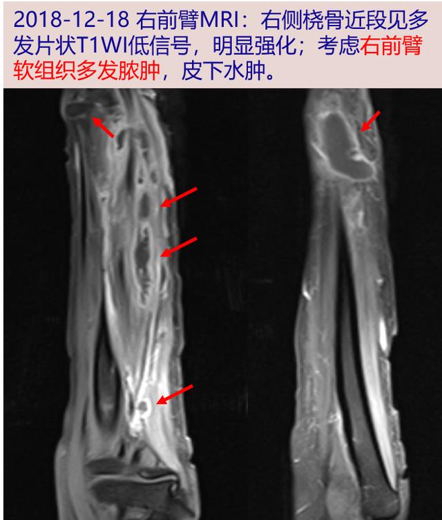 青年女子伤口狰狞、半年不愈，涂片检查发现元凶竟然是它……