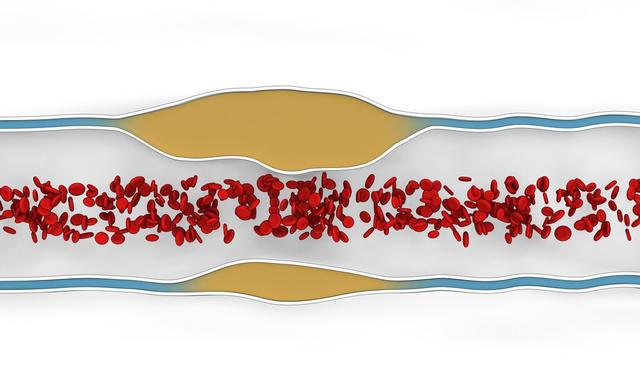 颈动脉发现了斑块，可以用阿司匹林治疗吗？不是所有人都需要