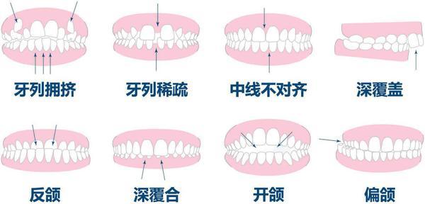 牙齿|口腔健康｜这个孩子的“地包天”口腔医生为何说不用矫正