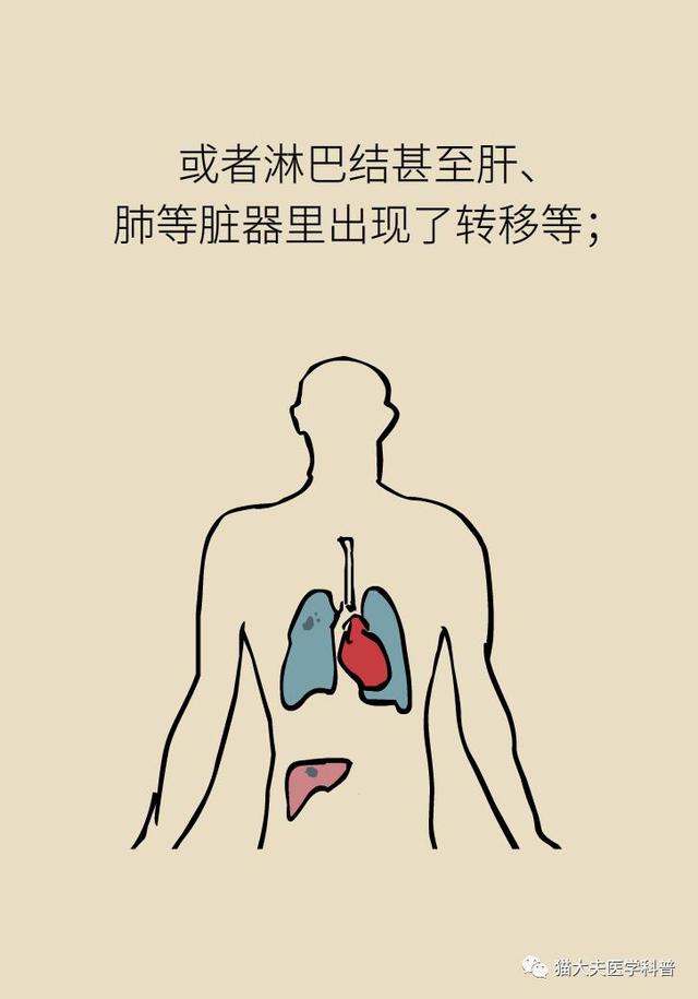 乳腺癌复发、转移了怎么办？