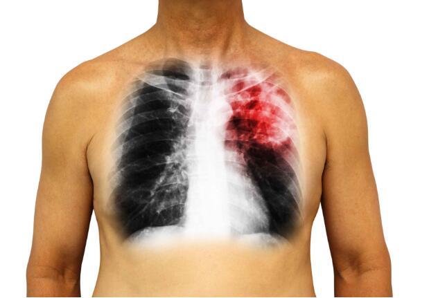 身体出现4个异常表现，或是肺在求救，癌细胞有动作了，别忽视