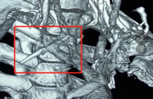 血管|小伙颈部取出“神秘飞针”！手术中同仁大夫都屏住了呼吸