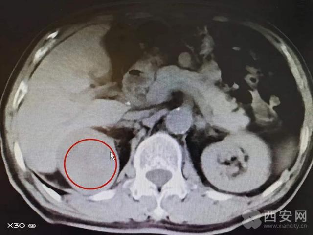 西安医学院第一附属医院 成功完成比常人多一倍肾动静脉的肾癌切除术