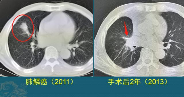 肺癌能治好吗？医生解释3个阶段的治疗数据，避免人财两空