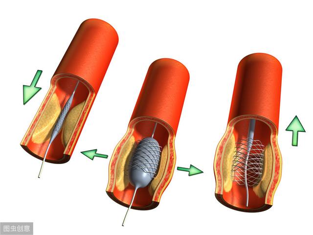 支架|“心血管造影显示堵80%，溶栓、装支架，病人该如何选择？”