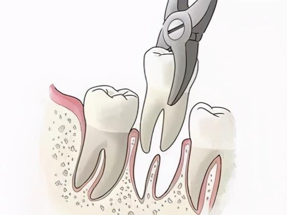 拔牙后不知所措，究竟是冰敷还是热敷？标准答案来了