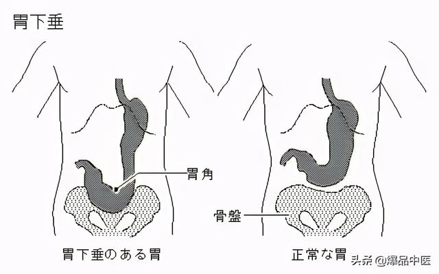 针灸中的秘术——提胃法