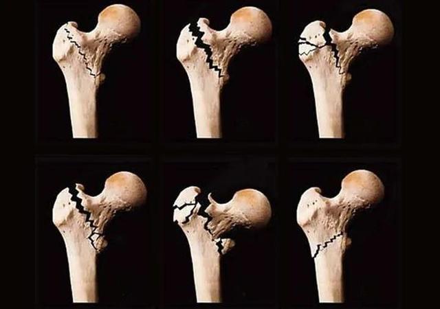 哪些外伤会引起股骨头坏死？