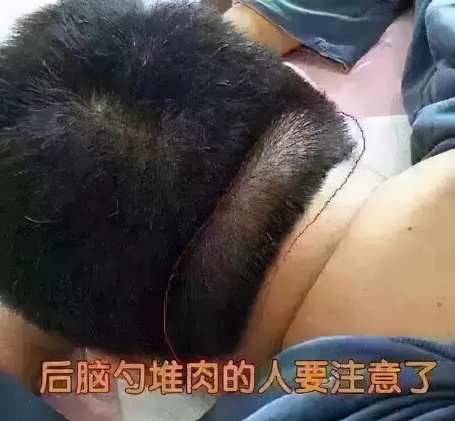 脑后堆肉，脑梗的前兆