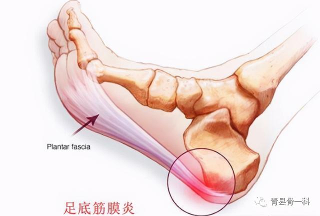 脚底疼痛是怎么回事？