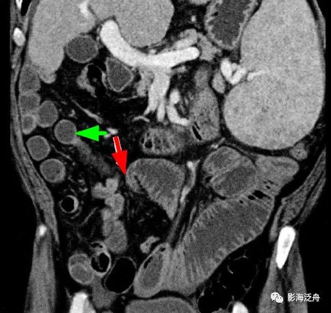这个病，腹部CT经常会漏诊