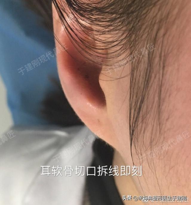 为什么宝妈都爱节假日做隆鼻？看完这篇，原来好处这么多