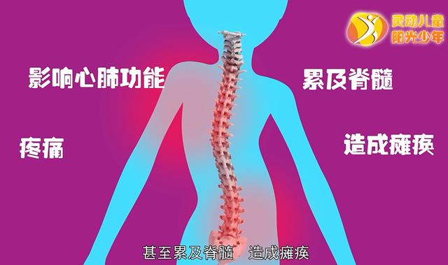 健康学堂|孩子高低肩，可能是病，这些脊柱侧凸自查方法，家长们一定要收藏