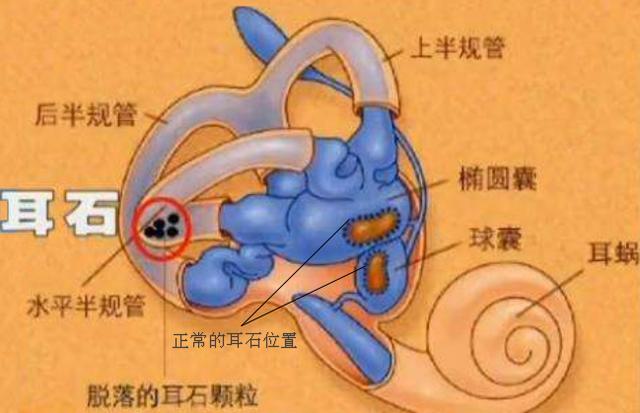 天旋地转|反复头晕眩晕？脑科医生：不一定是脑子有问题，病根有可能在耳朵