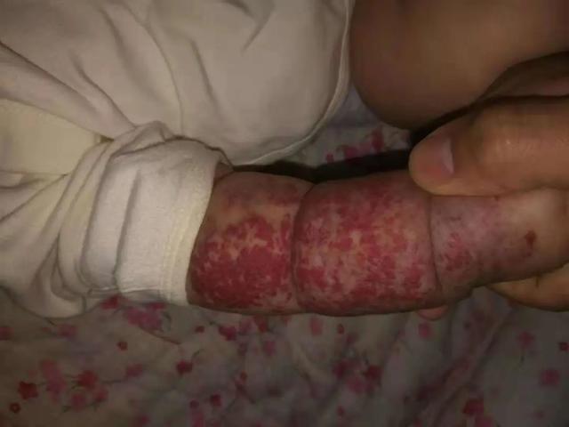 大河微医|新生宝宝手臂颜色似“鸡血石”？医生：这是病，得治
