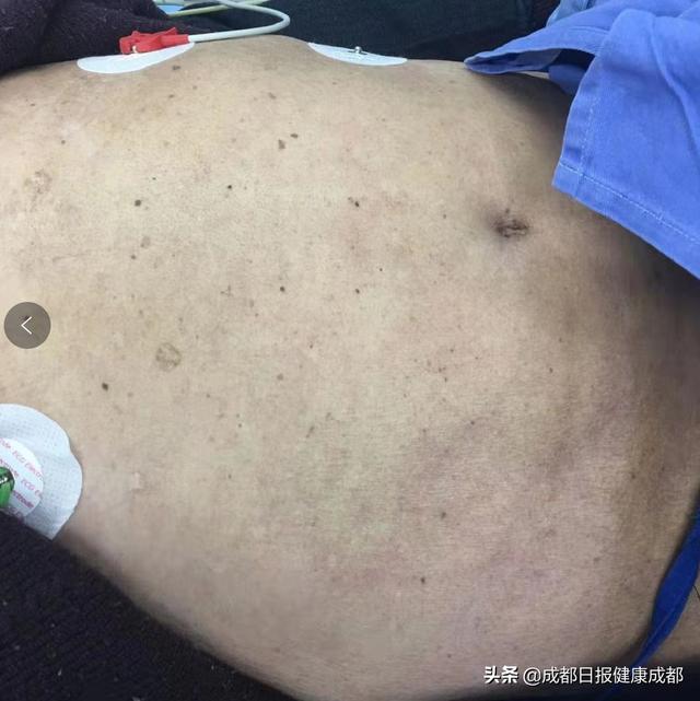 患者|24分钟打通老人堵塞血管！成都市五医院又一次印证区域协同作战重要性