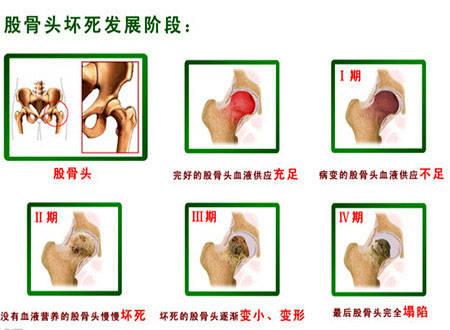 股骨头坏死2期开始塌陷了吗？