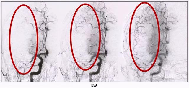 长寿冠心病患者的忠告：配齐几种药物，坚持吃才可能健康地活下去