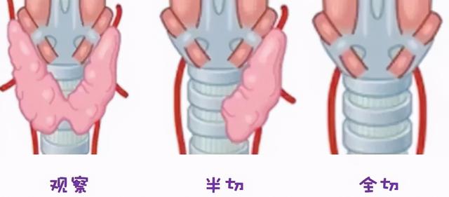 2021来了，甲状腺癌应该这样治