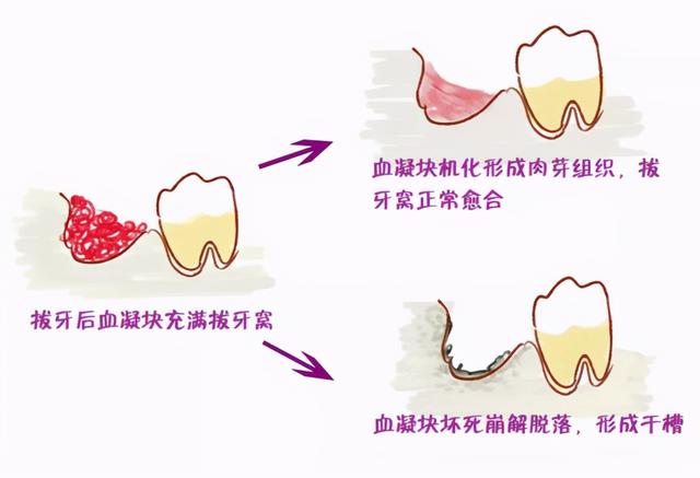 拔牙后不知所措，究竟是冰敷还是热敷？标准答案来了