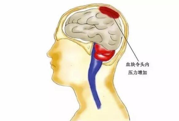 脑溢血|脑血管崩溃前有10个信号，大部分人都忽略了