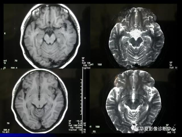 「影像复习」脑干区常见病变影像表现
