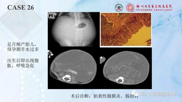 儿童腹部囊性病变诊断思路分析